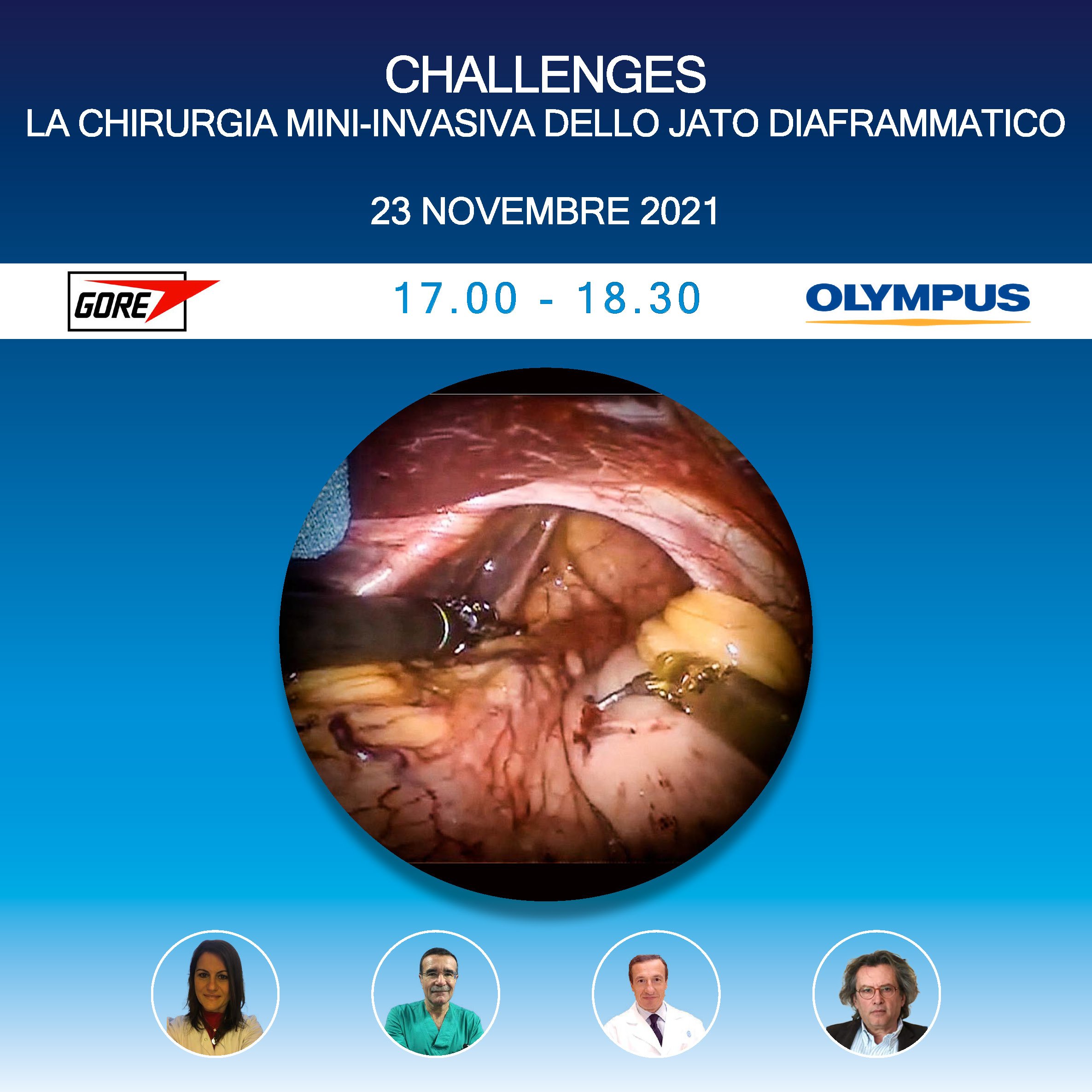 "Challenges" - La chirurgia mini-invasiva dello jato diaframmatico | Webinar